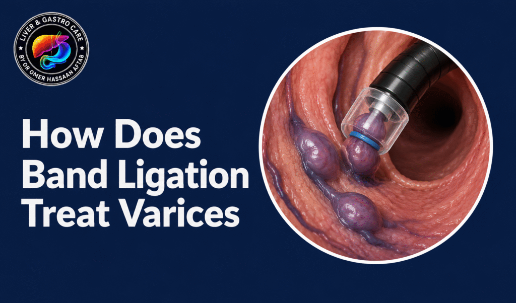 How Does Band Ligation Treat Varices