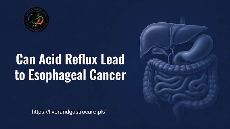 Can Acid Reflux Lead to Esophageal Cancer